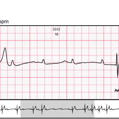 ECG Recorder – 14 Day Continuous – Biolab